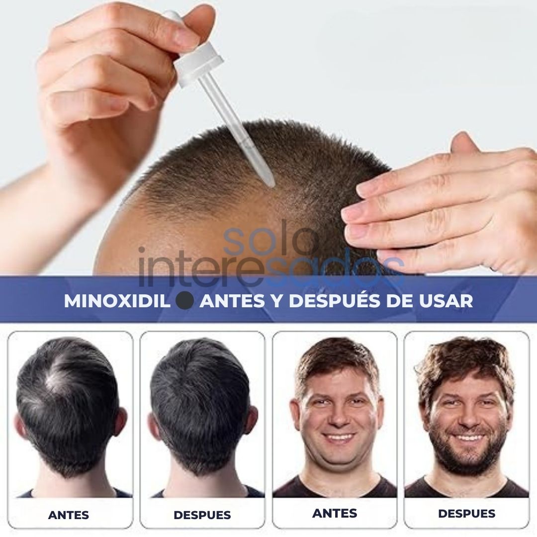 Minoxidil – Crecimiento Capilar y Regeneración Natural ORIGINAL 50ML (HOMBRES Y MUJERES)