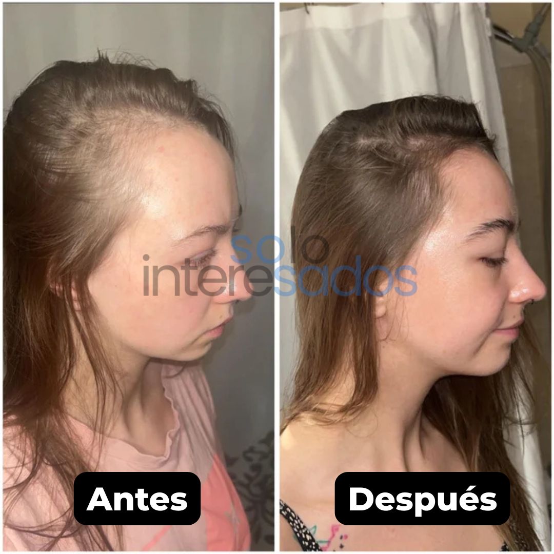 Minoxidil – Crecimiento Capilar y Regeneración Natural ORIGINAL 50ML (HOMBRES Y MUJERES)